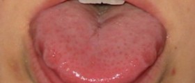 Pimples on tongue