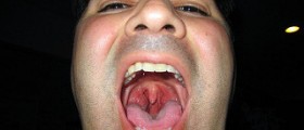 About irritated throat