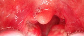 Chronic cryptic tonsillitis symptoms
