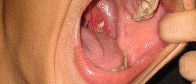 Itchy throat and ears
