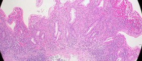 Digestion and ulcerative colitis