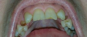 Abscessed tooth symptoms
