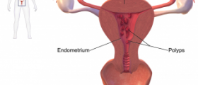 What are uterine polyps?