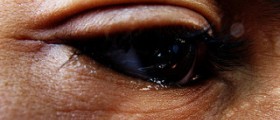 Watery eyes causes