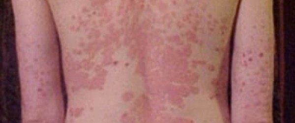 skin peeling on penis my wife love big black cock