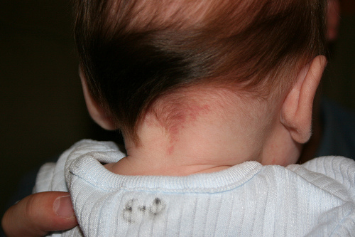 most-common-types-of-birthmarks-and-their-danger-levels-skin-hair