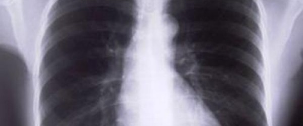 Cystic Fibrosis: Causes & Risk factors