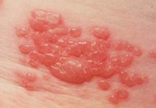 Impetigo in Adults: Condition, Treatments, and Pictures ...