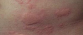 A rash on your skin might be a danger sign of yeast infection
