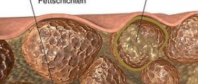 About acute cellulitis