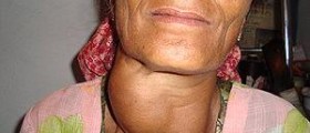 About benign goiter