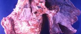About causes of mesothelioma