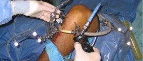 ACL surgery cost