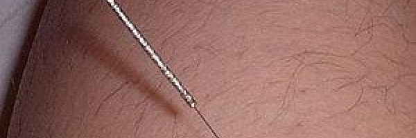 Acupressure the new cure for acid reflux ?