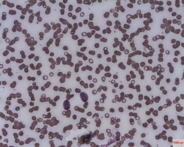 Acute liver disease