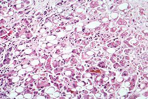 Alcoholic cardiomyopathy review