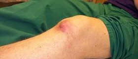 Alternative therapy for gout