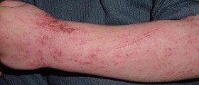 Atopic dermatitis cure