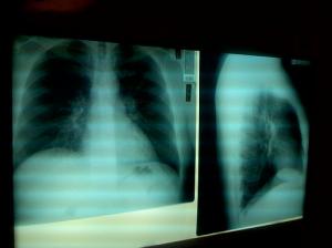 Bacterial pneumonia complications