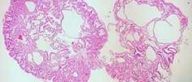 Benign gastric tumors