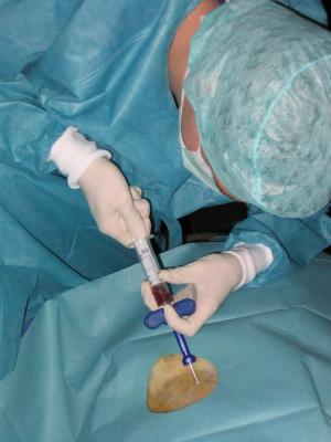 Bone marrow cancer