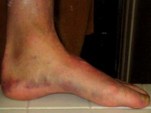 Bruised Heel Facts 