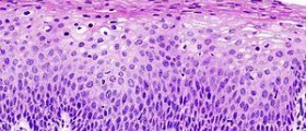 Cancer complications: Esophageal cancer care plan