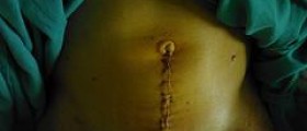 Chronic bowel pain