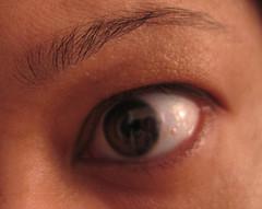 Chronic dry eye