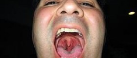 Chronic dry throat