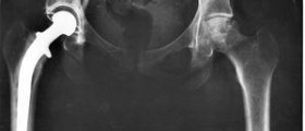 Chronic hip pain