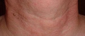Chronic laryngitis symptoms