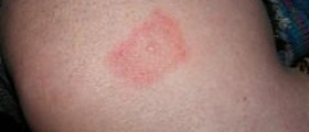 Chronic lyme disease