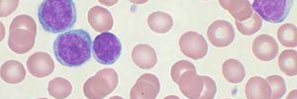 Chronic lymphocytic leukemia