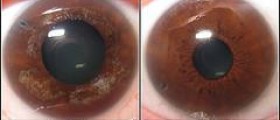Chronic narrow angle glaucoma