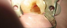 Chronic root canal infection