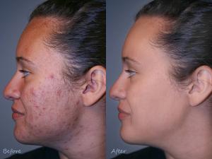 Clear skin fast with natural skin acne cure