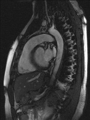 Congestive cardiac failure and its nursing management