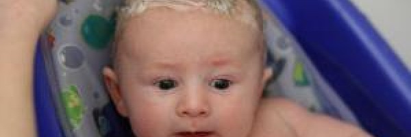 Cradle cap in infants
