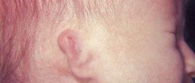 Deafness at birth