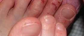 Dermatitis contact allergy