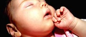 Dermatitis on baby face