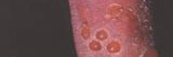 Drug allergy facts