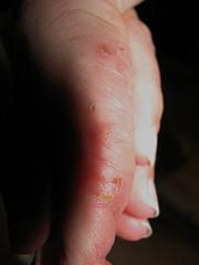 Dyshidrotic eczema cure