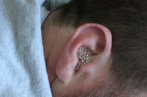 Red Bumps On Ear Lobe Symptoms - HealthTap