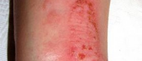 Eczema in toddlers