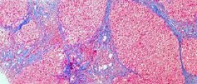 End stage of cirrhosis