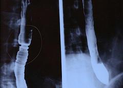 Esophageal cancer surgery side effects
