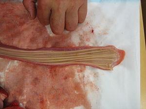 Esophageal cancer treatment