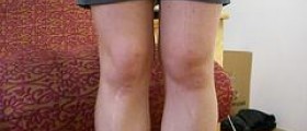 Exercise for people with arthritic knees